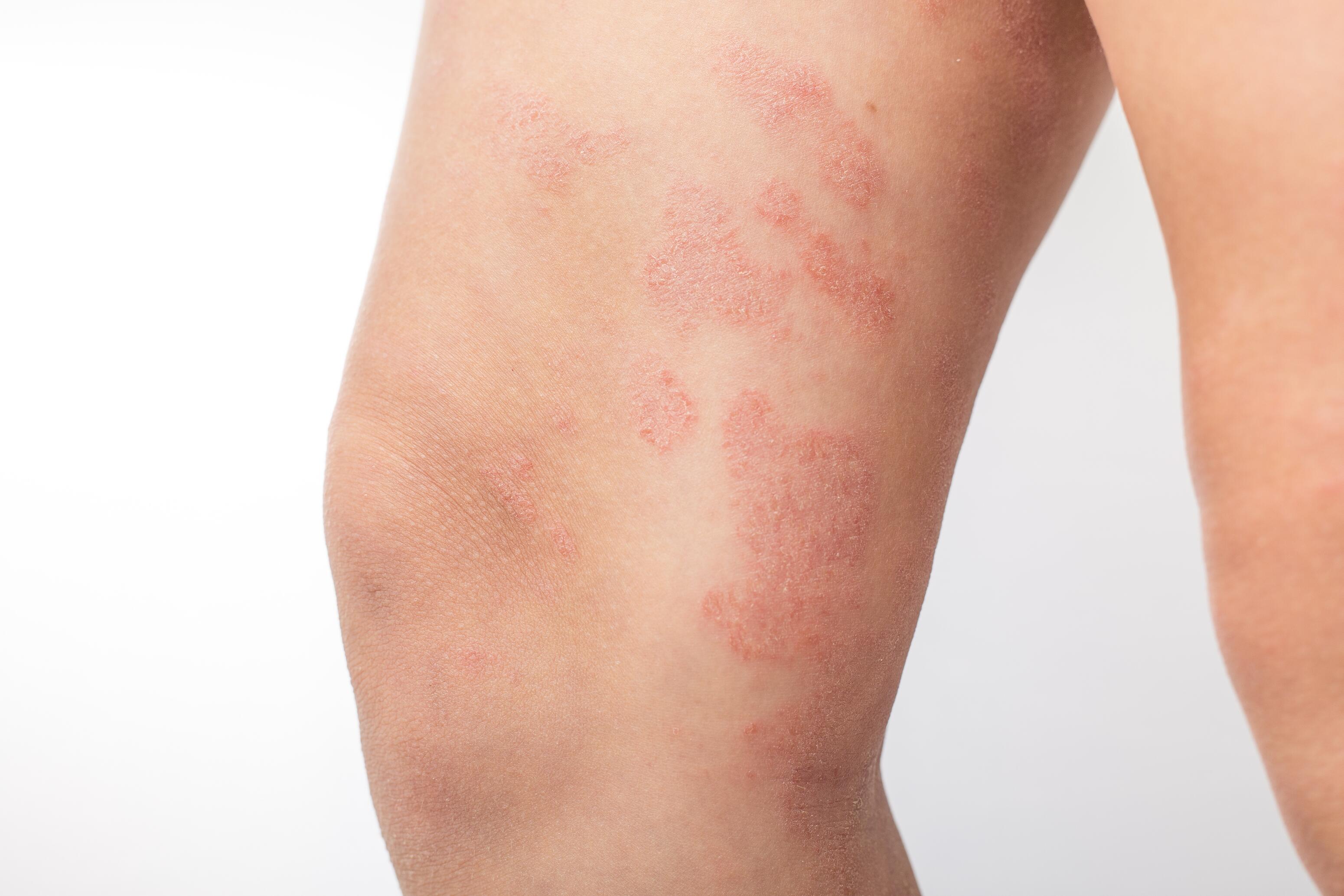 Eczema on the legs